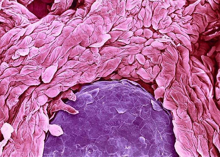 Si të largoni Psoriasis në mënyra të thjeshta në shtëpi