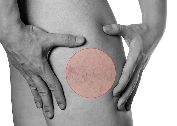 HIqni Venat dhe Variçet pa intervenim kirurgjik dhe pa ilaçe tradicionale