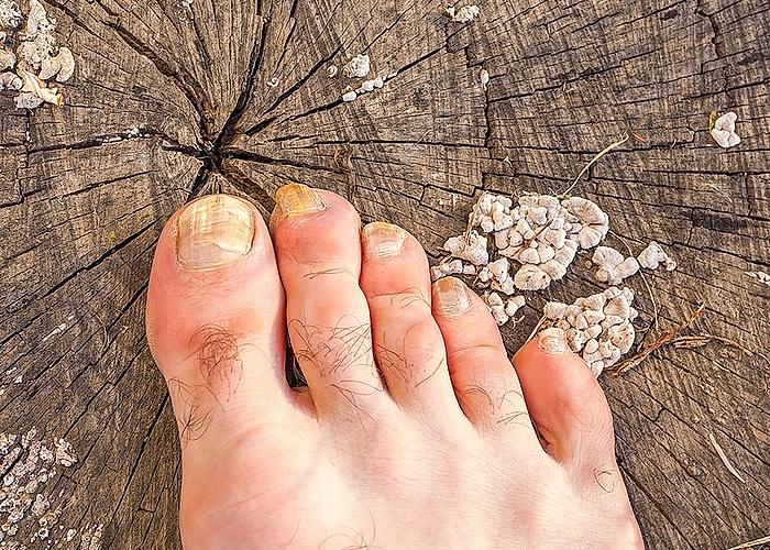 Ndiq këto hapa dhe largo përgjithmonë mykun e këmbëve!