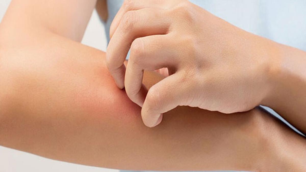 Largoni Psoriasis me metoda të thjeshta