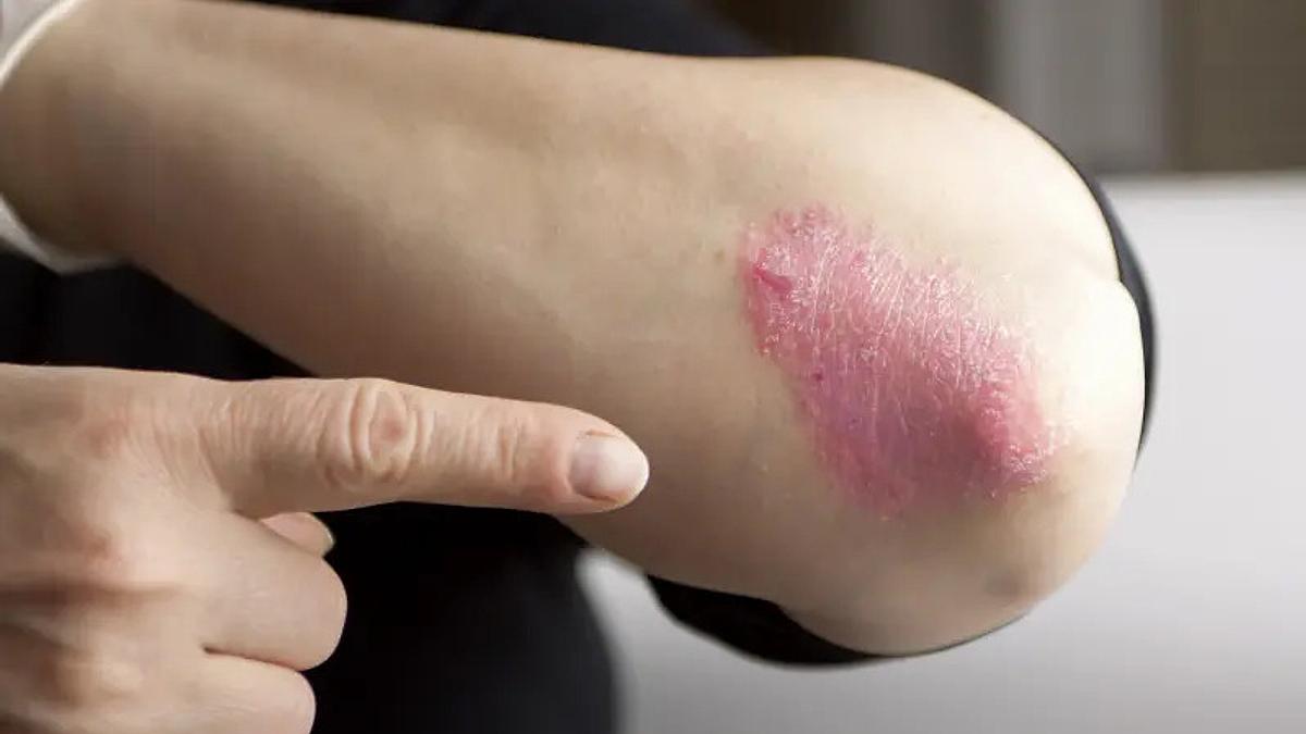 Thuaj lamtumirë shqetësimit të psoriazës - kjo mund të ndihmojë