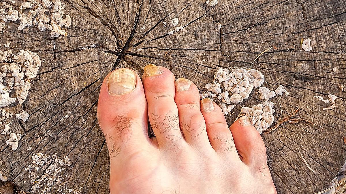 Ndiq këto hapa dhe largo përgjithmonë mykun e këmbëve!