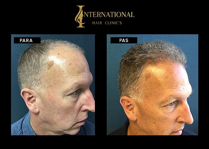 Mbjellja e flokëve me metodën FUE